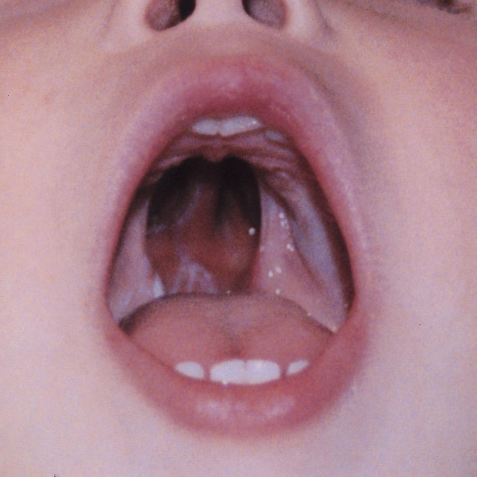 psdivya1267's tweet photo. A #cleftpalate is a split or opening in the roof of the #mouth. A cleft palate can involve the hard palate which is the bony front portion of the roof of the mouth and/or the soft palate, the soft back portion of the roof of the mouth.
Visit us @ https://t.co/yS1Z97Qn73 https://t.co/4cRRbTAUBa