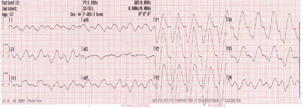 A 60-something who has non-specific generalized malaise and is ill appearing.

hqmeded-ecg.blogspot.com/2019/07/a-60-s…