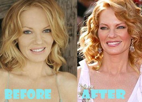 Marg Helgenberger Plastische Chirurgie. marg-plastic-surgery-hel. 