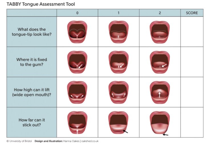 ISRHML's tweet image. Evaluation of a pictorial assessment tool (TABBY) for tongue-tie in breastfed babies doi.org/10.1186/s13006… Use of the TABBY + a structured #breastfeeding assessment can inform selection of infants for frenotomy.
