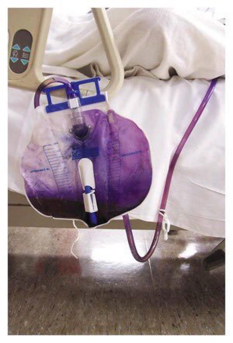 The Urine Rainbow, a thread.. starting with purple!This happens rarely with certain kinds of bladder infections in chronically catheterized patients. (Image from NEJM).I’ve also attached an article that describes a case study and more details. 1/ https://www.ncbi.nlm.nih.gov/pmc/articles/PMC3147034/