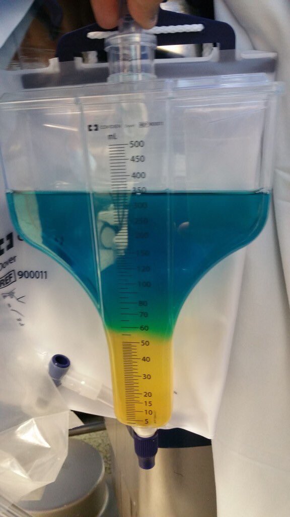 Here the colors are layered. Ever seen urine look like this before?This is a result of a blue dye administration during surgery. The layering is due to the timing of the dye infusion. The image is from the following article, fascinating! 2/ https://www.apicareonline.com/intraoperative-multi-colored-urine/