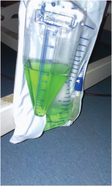 Propofol is an anesthetic/hypnotic used for induction and maintenance of general anesthesia as well as sedation in ICU patients. Oh, and it turns your pee green (as do many other things). 3/ https://www.ncbi.nlm.nih.gov/pmc/articles/PMC3766788/