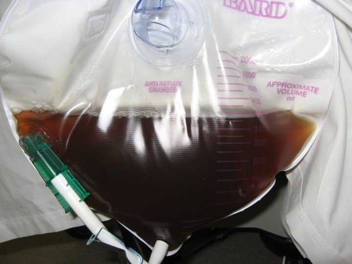 Dark brown or “tea colored” urine can be caused by many conditions, including liver failure, rhabdomyolysis (muscle breakdown), urinary tract infections, tubular necrosis, nephritis, severe dehydration, and certain foods/colorings. 4/