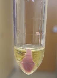 A bright pink urine sediment has been described in the setting of propofol administration with excretion of uric acid. (Image is from the article. Kinda looks like it’s sticking its tongue out at you doesn’t it?) 5/ https://www.kireports.org/article/S2468-0249%2818%2930238-9/pdf