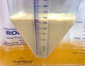White urine can be caused by pyuria (severe urinary tract infection and pus, like the image below), or chyluria (excretion of chyle, a body fluid consisting of lymph and emulsified fats). 6/  https://www.researchgate.net/publication/305687802_Milky_White_Urine_a_look_into_the_differentials