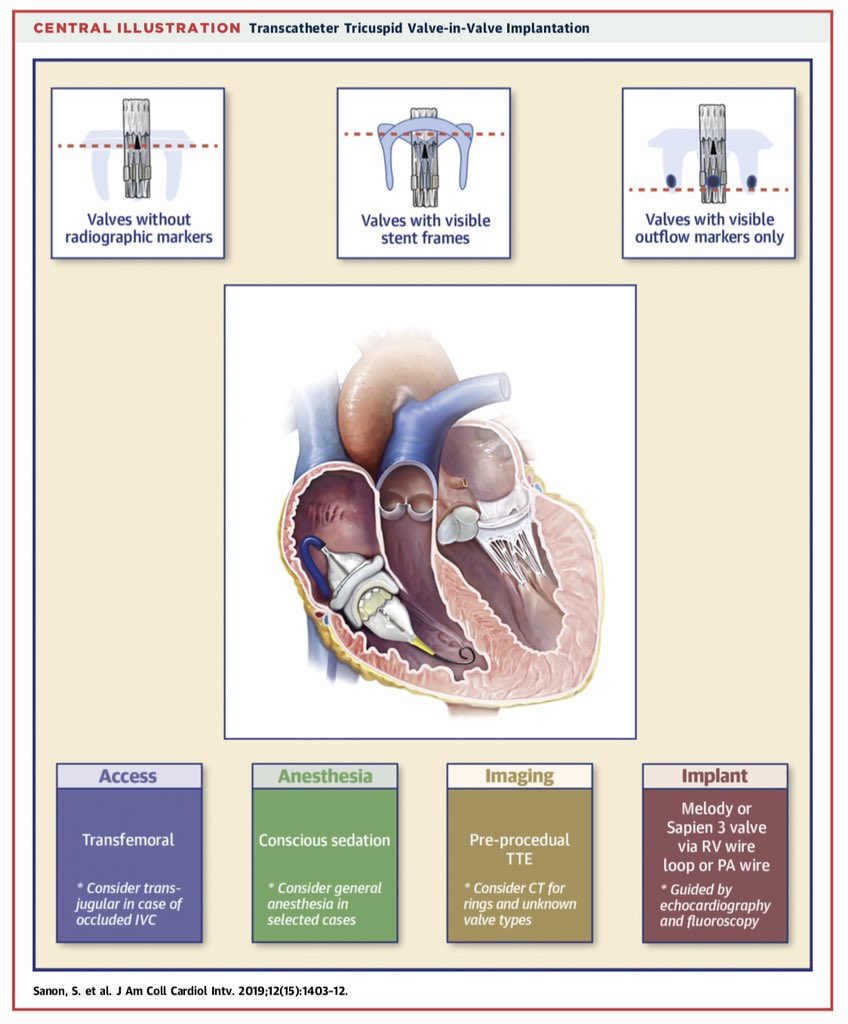 Saurabh Sanon (@sanonsaurabh) on Twitter photo Our new State-of-the-Art paper in <a href="/JACCJournals/">JACC Journals</a> reviews the fundamental principles of transcatheter tricuspid valve-in-valve and valve-in-ring implantation. <a href="/azeemlatib/">Azeem Latib</a> <a href="/allisoncabalka/">Allison Cabalka</a> <a href="/sameergafoor/">Sameer Gafoor</a> #JACCINT sciencedirect.com/science/articl… Our new State-of-the-Art paper in <a href="/JACCJournals/">JACC Journals</a> reviews the fundamental principles of transcatheter tricuspid valve-in-valve and valve-in-ring implantation. <a href="/azeemlatib/">Azeem Latib</a> <a href="/allisoncabalka/">Allison Cabalka</a> <a href="/sameergafoor/">Sameer Gafoor</a> #JACCINT sciencedirect.com/science/articl…