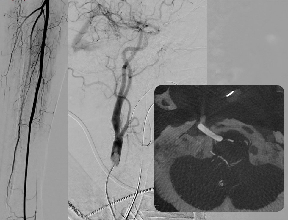 jildazz's tweet photo. 1/2
From arm to persistent hypoglossal a. : one of the persistent carotid-vertebrobasilar anastomoses (can also be described from CT or MR scans)
#anatomy #radiology @Radiopaedia @radiology_rsna
Distal #radialfirst occluded so ๐ #Ulnarfirst #Ulnar4Neuro https://t.co/yM26Ph5HVQ