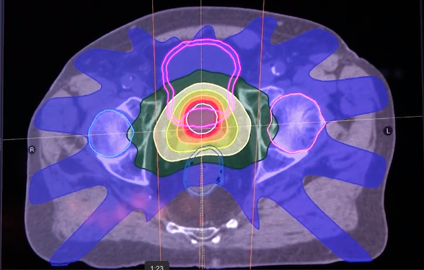 DAICeditor's tweet photo. VIDEO: Use of Machine Learning to Automate Radiotherapy Treatment Planning - with Leigh Conroy, Ph.D., Princess Margaret Cancer Center, Toronto.
https://t.co/feUnifdTpM
#AAPM2019 @RaySearch #radiotherapy #RadiationOnc #medicalphysics #rtplanning #ArtificialIntelligence https://t.co/ELZZ9P36dr