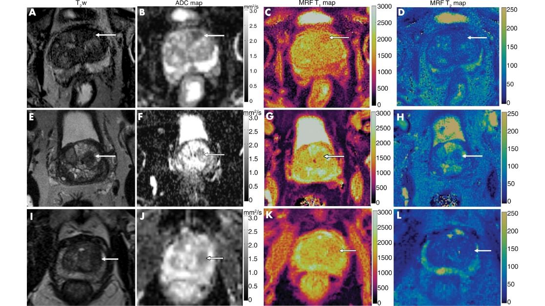 radiology_rsna's tweet photo. MR fingerprinting-based relaxometry with ADC mapping can help characterize lesions in the #prostate TZ which can often be diagnostic dilemmas! https://t.co/TPyrxiXC5j @AnanyaPanda15 @MRIvikas @mrimark @MayoRadiology @cwru #prostatecancer #GUrad https://t.co/MAiY8jBoPI