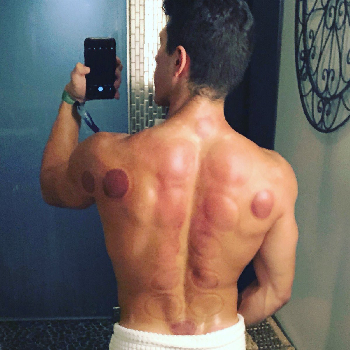 TheSpaonRodeo's tweet photo. Have you had a #cupping massage? It’s a relaxing way to detox! The marks are signs of toxins being flushed out of the body 🙌🏼 Call us for more information ☎️ 424-284-8040 #cuppingtherapy #cuppingmassage #thespaonrodeo https://t.co/wwFXd1fL0U