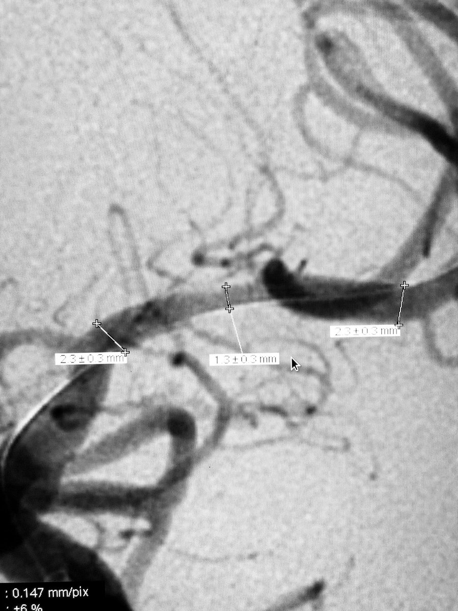 AmeerEHassan's tweet photo. How much ICAD do you see post mechanical thrombectomy?? 7 days post second #Stroke on DAPT treated today with angioplasty and stenting with wingspan. New tools on the way and hopefully a new trial first HALF of 2020! #ICAD #RECURRENTSTROKE #WEAVE https://t.co/mHXPA0m0cI