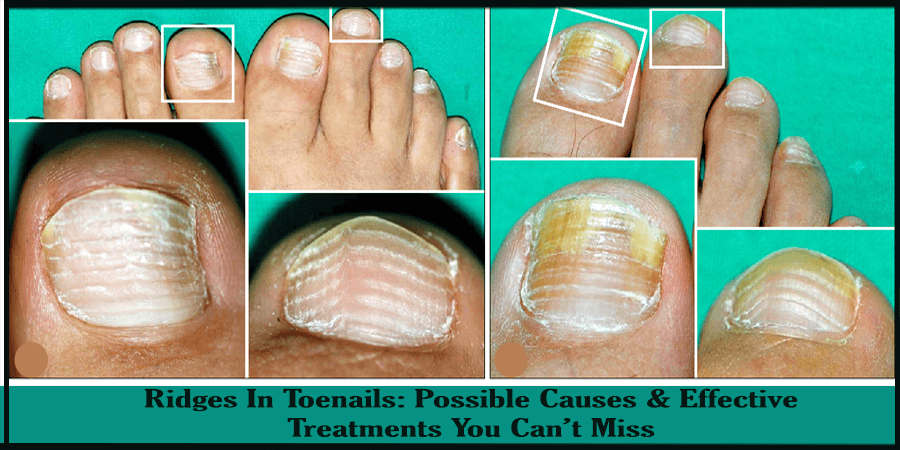 Cure Toe Nail on Twitter: Cure Toe Nail on Twitter: