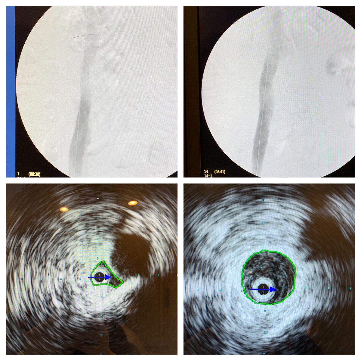 drscotthollandr's tweet photo. Very hard to believe right leg pain and swelling with numbness over 10 years. Severe right common iliac vein compression pre and post treatment.
#vascularspecialist #drscotthollander #vein #veins #venous #venogram #IVUS #stent #angioplasty #interventionalradiologist https://t.co/6LQZMll32C