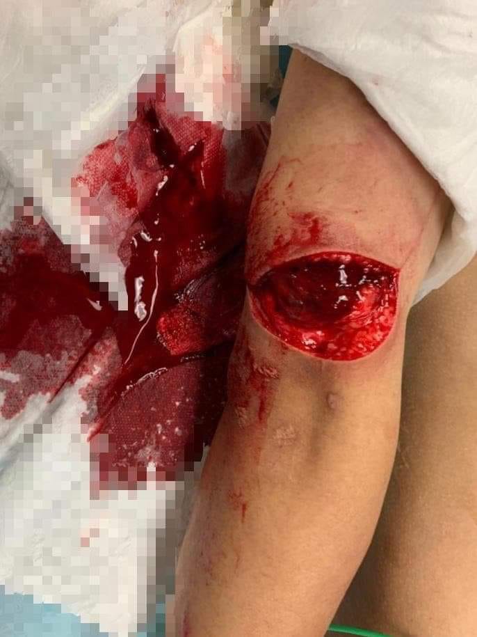 YaweiB's tweet photo. A protester attacked by gang member in HK. Wound deep to the muscle layer, not sure if neurovascular injury from the pics. 
#HKprotests #China #XiJinping https://t.co/3KltFwlryv