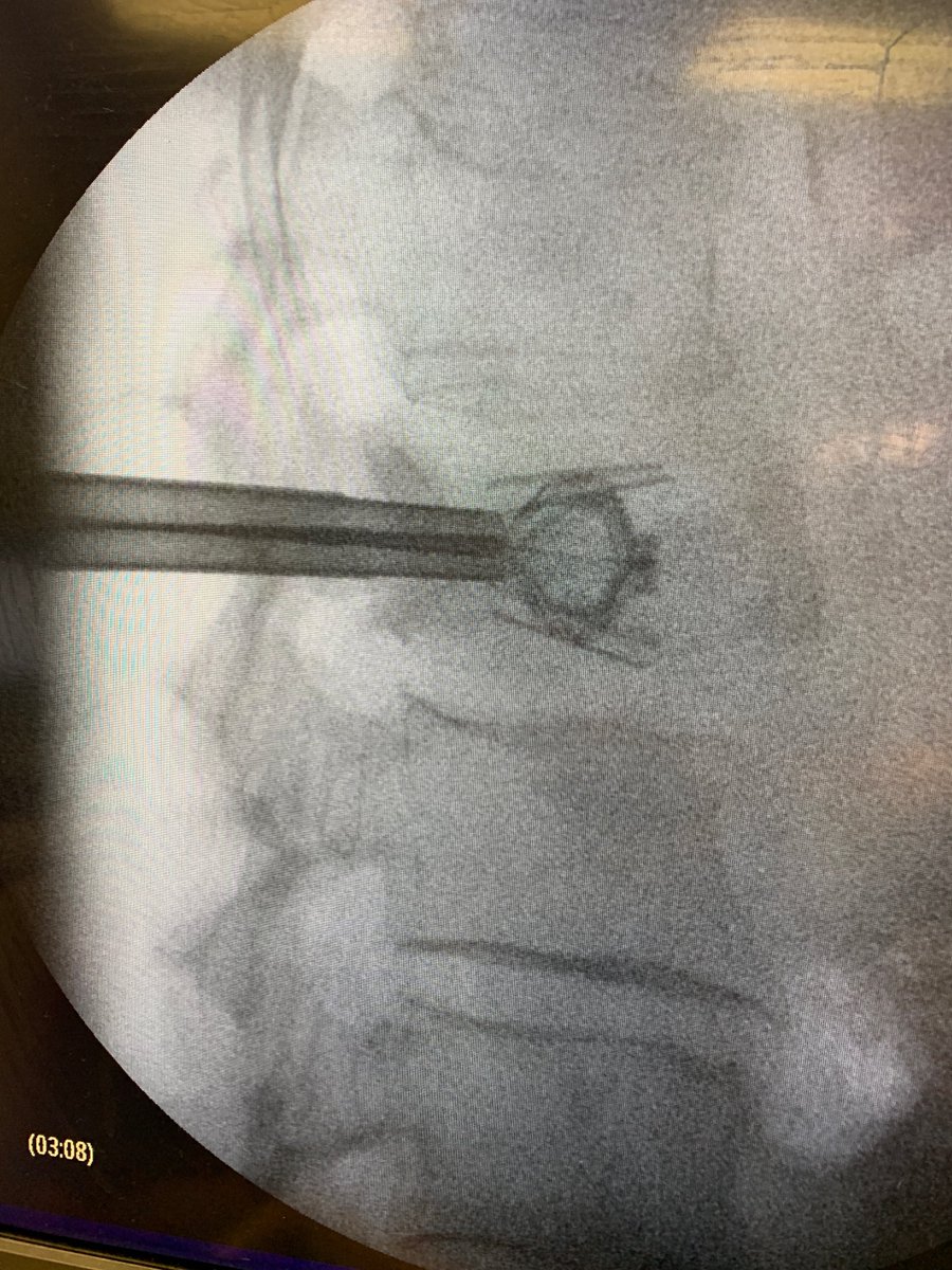 Christopher Paul, MD (@cpaulmd) on Twitter photo 82 yo F offered "conservative" treatment. 2 mo. of 10/10 pain to 0/10. Vertebral augmentation is life saving therapy that should be considered for every patient with symptomatic VCF. Educating referring providers is key. It's an uphill battle. @uamspain <a href="/dougbeall/">Douglas Beall</a> <a href="/WayneOlan/">Wayne Olan</a> 82 yo F offered "conservative" treatment. 2 mo. of 10/10 pain to 0/10. Vertebral augmentation is life saving therapy that should be considered for every patient with symptomatic VCF. Educating referring providers is key. It's an uphill battle. @uamspain <a href="/dougbeall/">Douglas Beall</a> <a href="/WayneOlan/">Wayne Olan</a>