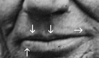 9/This theory is based on lumps noted around his mouth, which might have been mucosal neuromas, and that his mother and several of his children died of wasting diseases, which might have been cancer.  https://bit.ly/2Z1dvWN&nbsp;