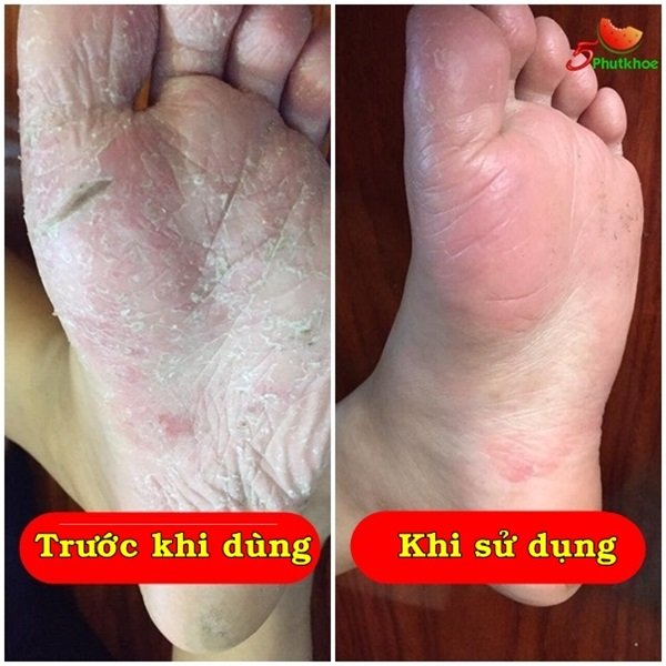 5phutkhoe's tweet photo. Dùng cho #dakhô, #nứtnẻ, #vếtthươnghở, #liềnsẹo.
Dùng cho các #bệnh_ngoài_da như: #viêm_da_cơ_địa, #chàm_da, #á_sừng, #vảy_nến, #ghẻ_lở, #hắc_lào, #nổi_mề_đay, #bệnh_tổ_đỉa, #lác_đồng_tiền
--------
👇Xem sản phẩm miễn phí tại đây👇
https://t.co/5N6IzieL2n https://t.co/dBanIGvjX0
