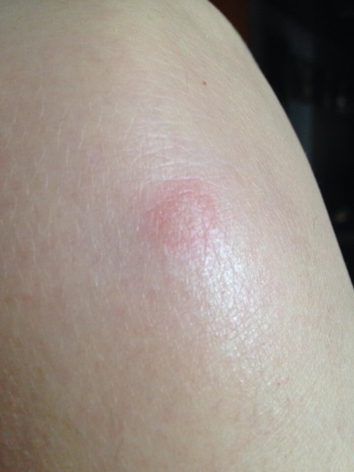 MaIsabel2026's tweet photo. Odio a los "marditos" mosquitos tigre...😫😫
#byeverano https://t.co/BBie1QPIrJ
