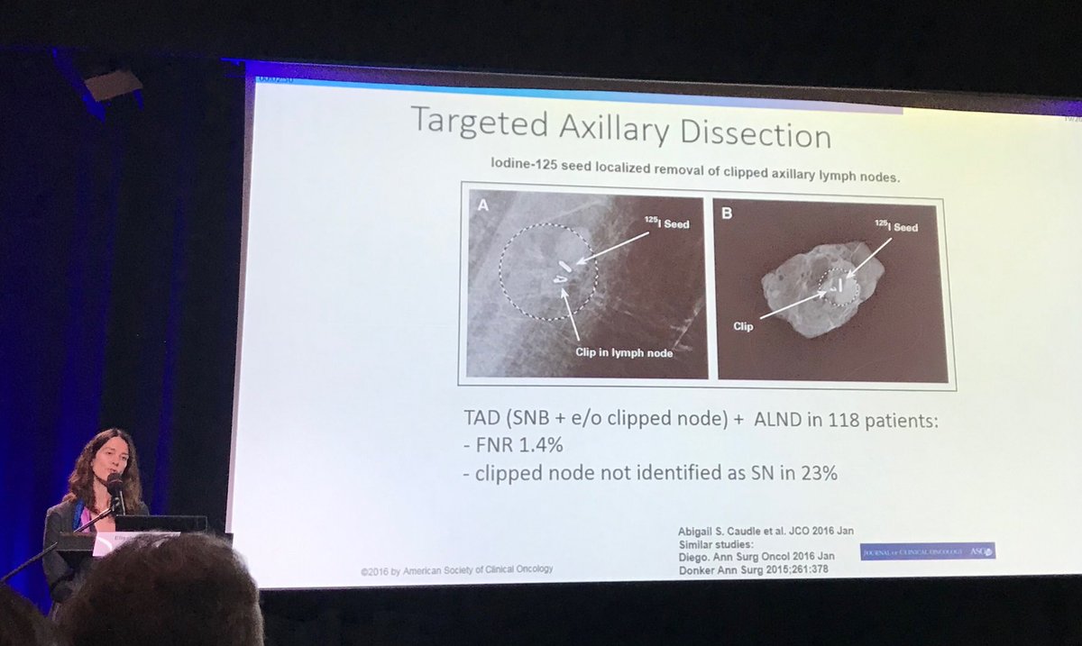 DianeRadfordMD's tweet photo. Data ⁦@AbigailCaudleMD⁩ targeted axillary dissection (clipped node) post NAC reduces false negative rate to under 2%. If rely on SLNBx miss clipped node in 23% #WCS2019Krakow https://t.co/fd29pXcFNS