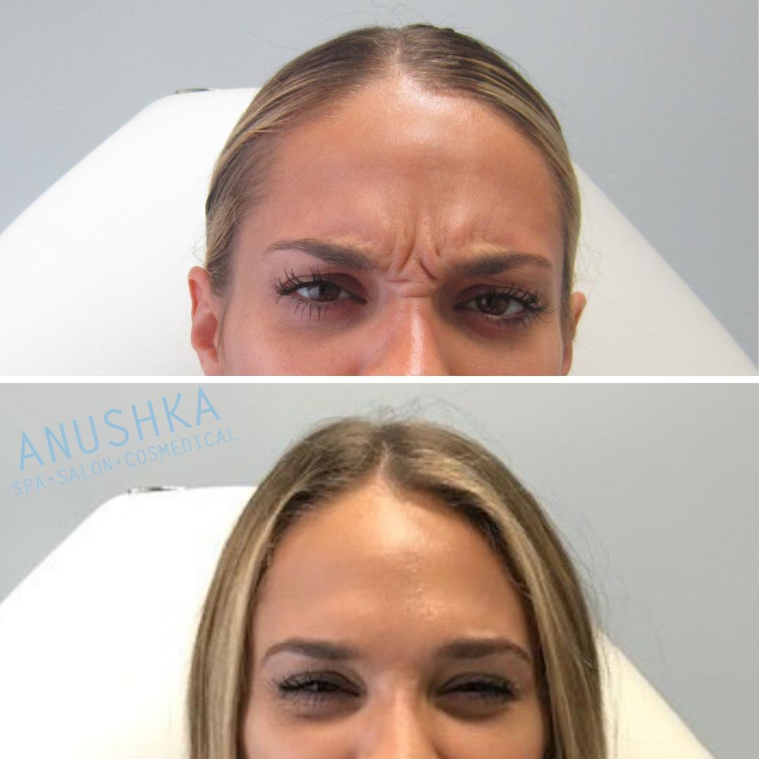 AnushkaSpa's tweet photo. Did you know …..
.
.
Neurotoxin injections like Botox &amp; Dysport used judiciously can refresh and maintain natural looks at any age while getting rid of those stubborn lines?!?
.
.
#botox #botoxforehead #botoxface #botoxfiller #botoxcapilar #botoxlips #botoxfacial #botoxparty https://t.co/8hPSzzV8vk