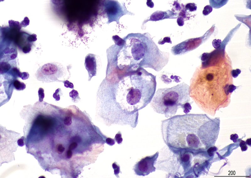 MyCytopathology's tweet photo. What is the best management of a 23 years old woman with 3 consecutive pap smears showing the findings below: https://t.co/tJKt6bwVj6