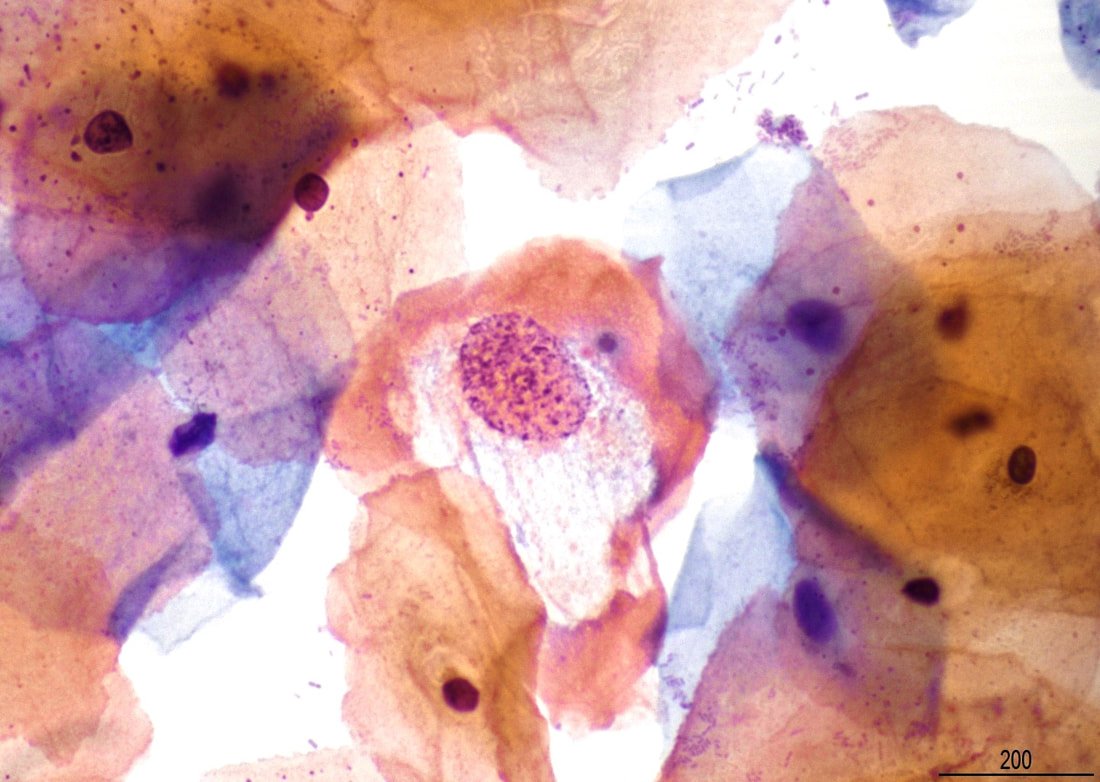 MyCytopathology's tweet photo. What is the best management of a 23 years old woman with 3 consecutive pap smears showing the findings below: https://t.co/tJKt6bwVj6