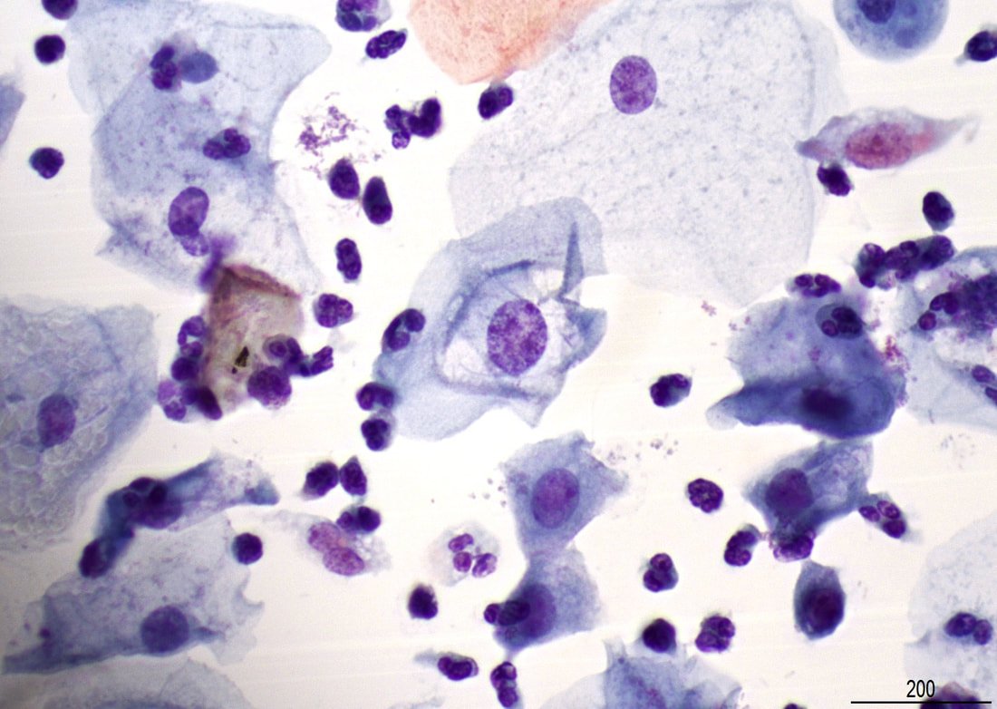 MyCytopathology's tweet photo. What is the best management of a 23 years old woman with 3 consecutive pap smears showing the findings below: https://t.co/tJKt6bwVj6