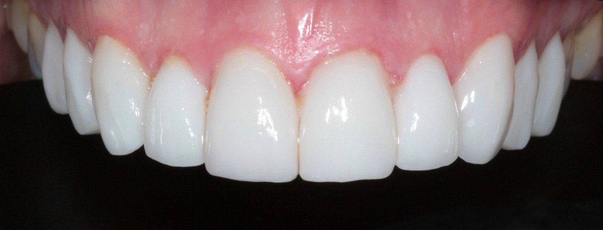 This patient was unhappy about the colour and unevenness to her upper teeth. Dr Heather Cowie improved this smile with teeth whitening, veneers and crowns and the patient was delighted with her results #berkeleyclinic #glasgow #dentist #veneers #crowns #whitening