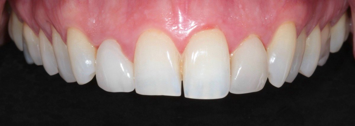berkeleyclinics's tweet photo. This patient was unhappy about the colour and unevenness to her upper teeth. Dr Heather Cowie improved this smile with teeth whitening, veneers and crowns and the patient was delighted with her results #berkeleyclinic #glasgow #dentist #veneers #crowns #whitening https://t.co/UPFvjXOTgH