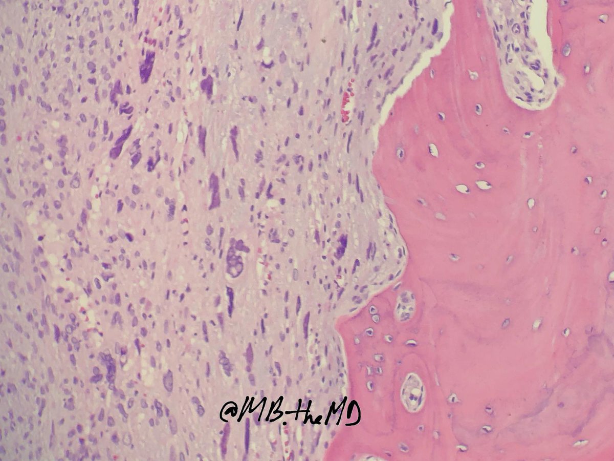 MB_thepathMD's tweet photo. #pathology #pathresident #pathfellow #pathArt #Boneandsofttissue #whatisit https://t.co/HjMkxesvml