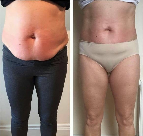 VisageLa's tweet photo. 💥LIPOFIRM PRO💥
BESPOKE PACKAGES AVAILABLE 
INBOX FOR DETAILS OR CALL
07949864642 COUSE OF 8 SESSIONS OR TOP TO TOE PACKAGES 💥
#lipofirmpro #cellulitereduction #inchloss #fatreduction #skintightening #dualmuscleaction #radiofrequency #beachready 👗👙 https://t.co/Yq9EFOyzAt