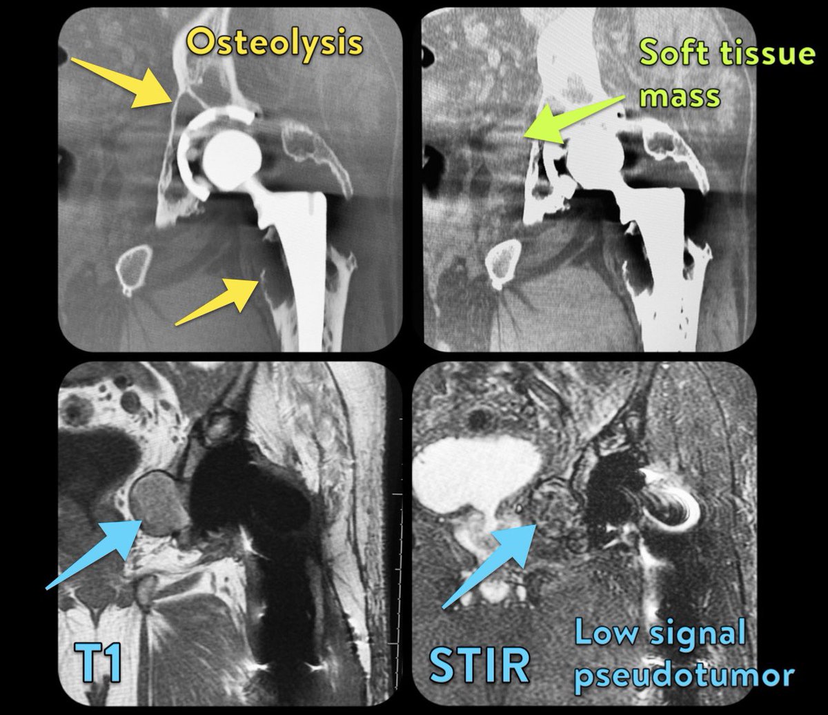 morrisonMSK's tweet photo. Adverse local tissue reaction (ALTR) in a failing hip replacement! 
https://t.co/Vz3IIQ1eaj https://t.co/pJBw0UM0cC
