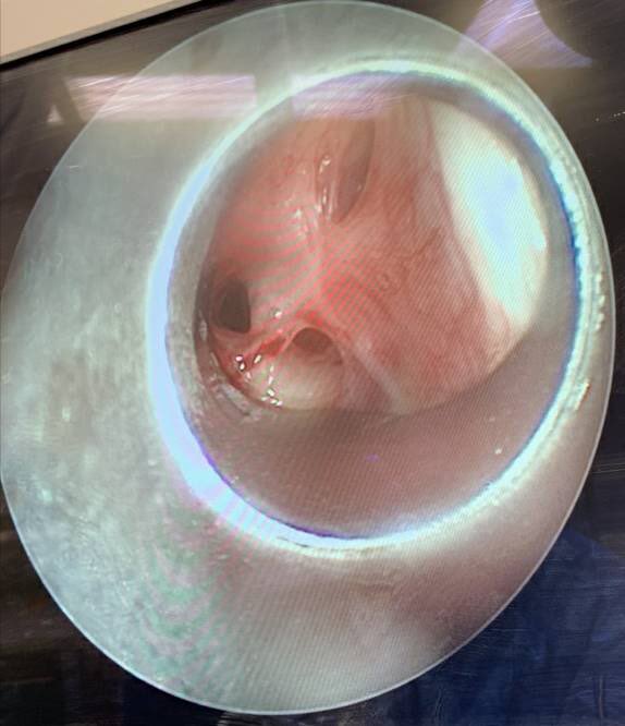 dfellerk's tweet photo. As Chevalier Jackson said, “not all that wheezes is asthma”. 42yo with Dx of “asthma”, actually with idiopathic subglottic stenosis. Talk about breathing through a straw! https://t.co/O95Ob9zCHd