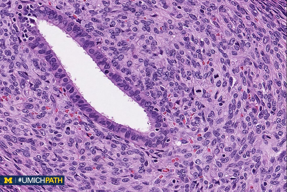 UMichPath's tweet image. A: (Müllerian) adenosarcoma. Malignant stroma w/ associated benign epithelium (endometrioid or metaplastic); has “Phyllodes-like” architecture w/ stromal condensation. Can be low grade or have sarcomatous overgrowth (&amp;gt;25%) w/ high grade or heterologous sarcoma. #GYNPath #DailyDx