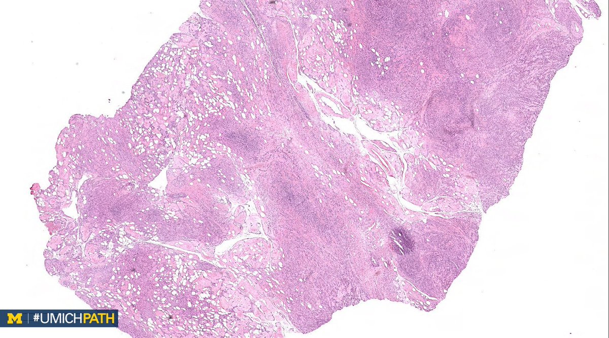 UMichPath's tweet image. 🔬#GYNPath, Day 2

➡️What’s your #DailyDx of this uterine mass?

➡️We’ll tweet the answer, some quick facts, and the next case tomorrow! #UMichPath