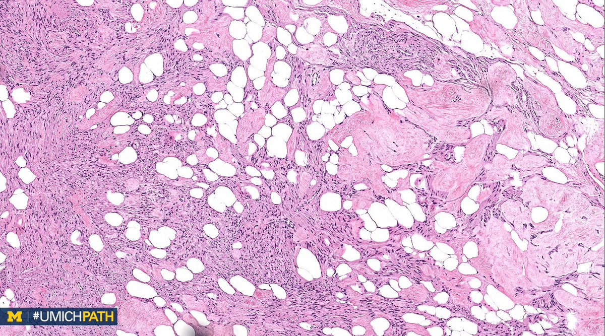 UMichPath's tweet image. 🔬#GYNPath, Day 2

➡️What’s your #DailyDx of this uterine mass?

➡️We’ll tweet the answer, some quick facts, and the next case tomorrow! #UMichPath