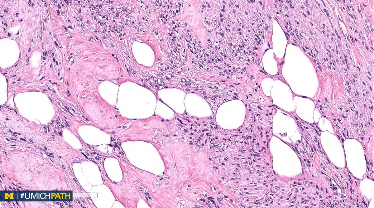 UMichPath's tweet image. 🔬#GYNPath, Day 2

➡️What’s your #DailyDx of this uterine mass?

➡️We’ll tweet the answer, some quick facts, and the next case tomorrow! #UMichPath