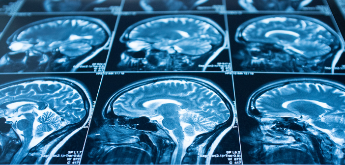 MS_Focus's tweet photo. Researchers peered inside the brains of hundreds of MS patients finding smoldering spots in the brain may signal severe MS.
Read more- https://t.co/eDAv5rGmJG
#MSresearch #MSAwareness #MultipleSclerosis #MSJourney #MSFocus #MSNews #MultipleSclerosisFoundation https://t.co/JAtWUjFb7K