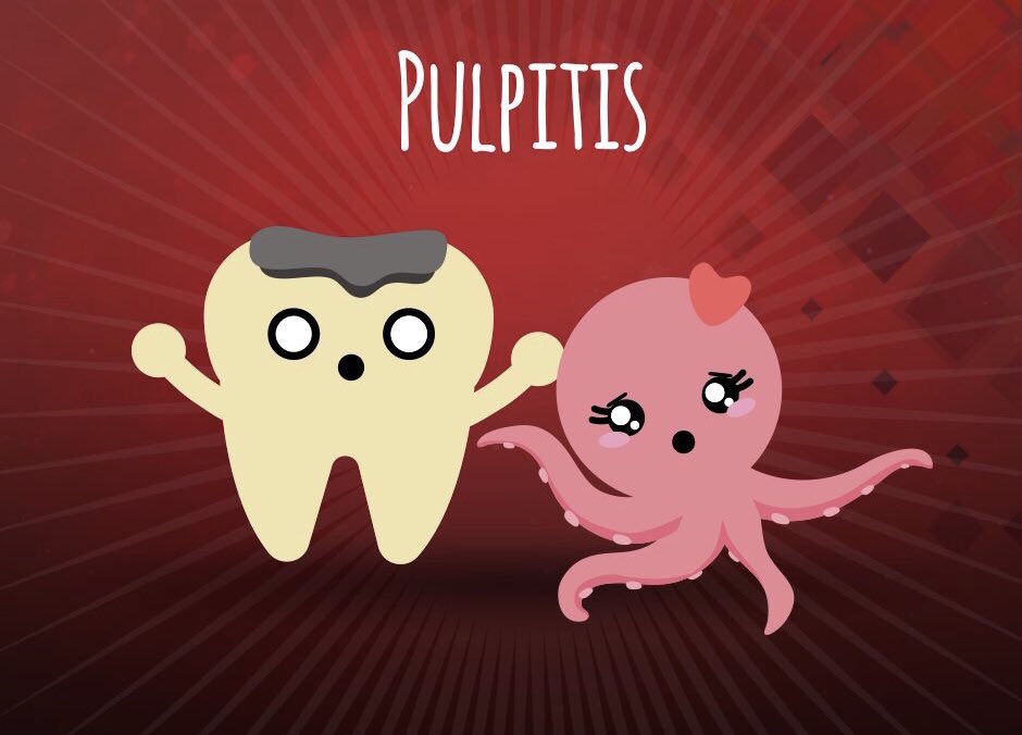 ConsulElAngel's tweet image. La #Pulpitis se define como un proceso inflamatorio que afecta a la #PulpaDental (el tejido blando que contiene los nervios y los vasos sanguíneos), como consecuencia de:
-Caries.
-Infecciones.
-Fracturas de la corona o raíz.
-La acción de algunos materiales. #Endodoncia