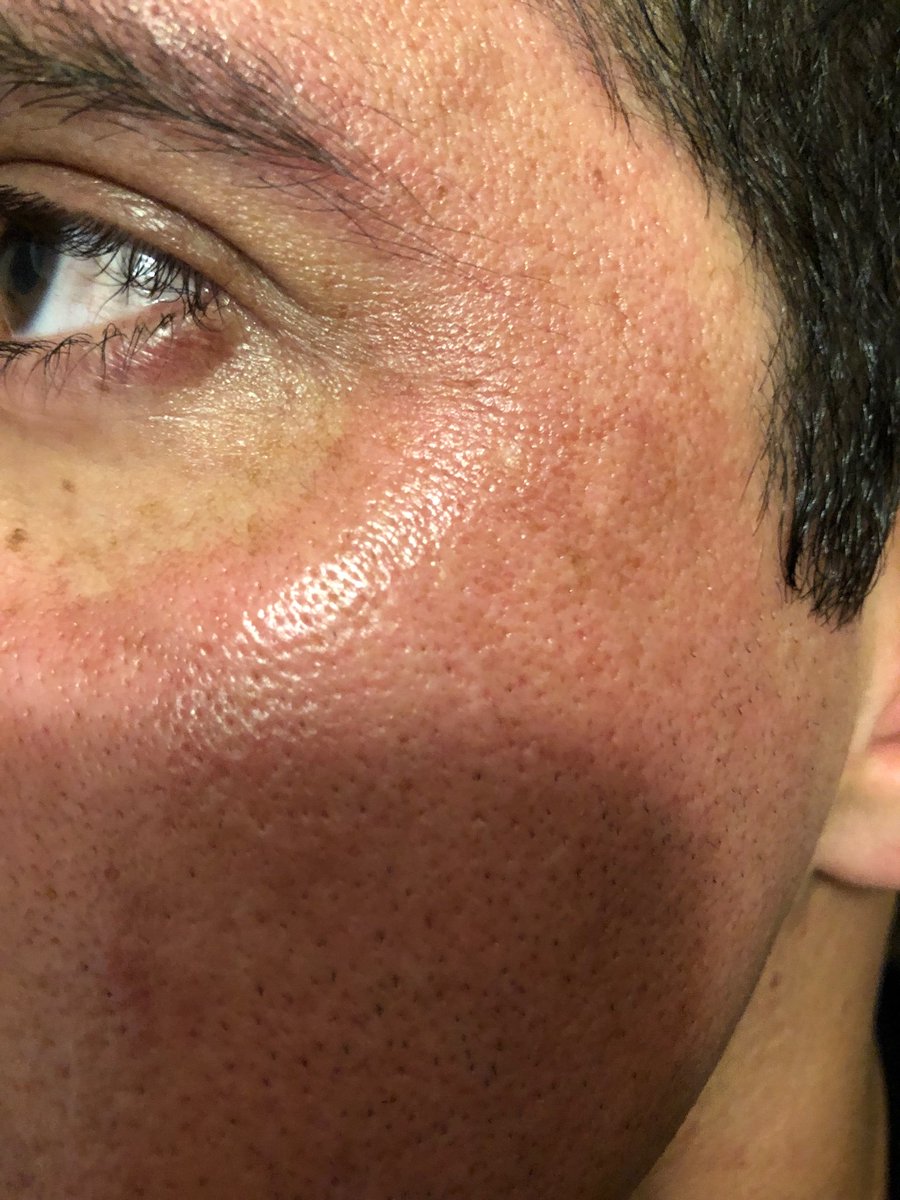 jennybvo's tweet photo. Blue Agave de @bioreus quema la cara, la compre x hipoalergenica y dermatológica mente probada NO tiene ningun warning de quemaduras!! Exijo mi dinero de vuelta! #biore https://t.co/fIBxxDDPG9