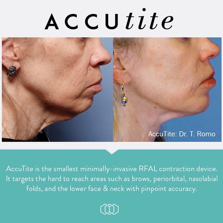 InmodeUK's tweet image. PINPOINT ACCURACY ⁣
#AccuTite is small and powerful. It is a minimally invasive solution using radio frequency to target hard to reach areas. AccuTite delivers precision heating like never before! Look at these results ⁣
.⁣
.⁣
#inmode #accutite #beforeandafter #doublechin