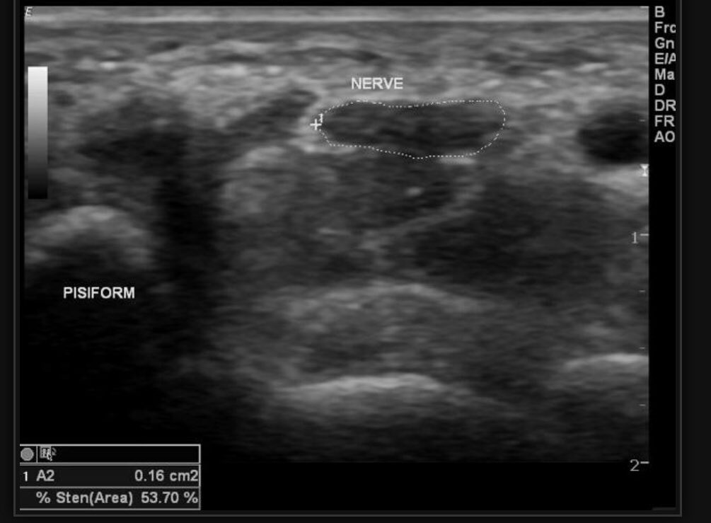 eurjther's tweet photo. Role of ultrasonography in patients with mild and moderate carpal tunnel syndrome https://t.co/fpbTHeE2VS  #ultrasonography #carpaltunnel #orthopedics #ultrasound #medtwitter #gaziantepuniversity #medicine https://t.co/T9z2bsUhH5