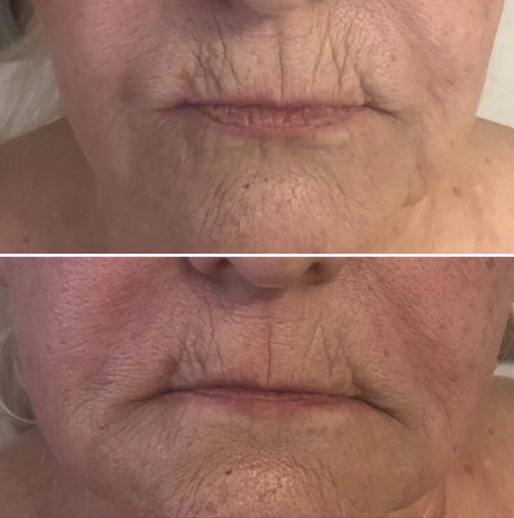 VisageLa's tweet photo. 💥LIPOFIRM PRO💥
BESPOKE PACKAGES AVAILABLE 
INBOX FOR DETAILS OR CALL
07949864642 COUSE OF 8 SESSIONS OR TOP TO TOE PACKAGES 💥
#lipofirmpro #cellulitereduction #inchloss #fatreduction #skintightening #dualmuscleaction #radiofrequency #beachready 👙#facial #antiageing #collagen https://t.co/G0g8DNIm13
