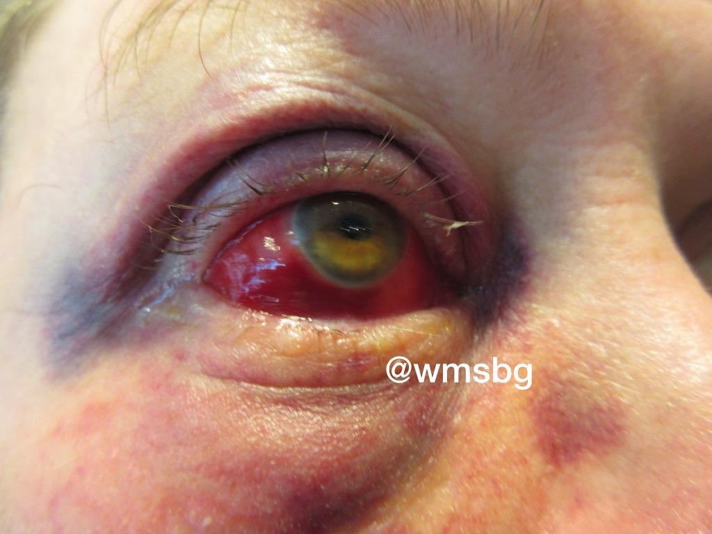 WMSBG's tweet image. Pictures of elderly jew who was viciously attacked on Monday morning by 4 thugs on Wythe pl, and broke his eye socket, @NYPD90Pct @NYPDDetectives is still looking for the suspects, contact @NYPDTips 800577TIPS or @WspuShomrim 7182370202 with any info.