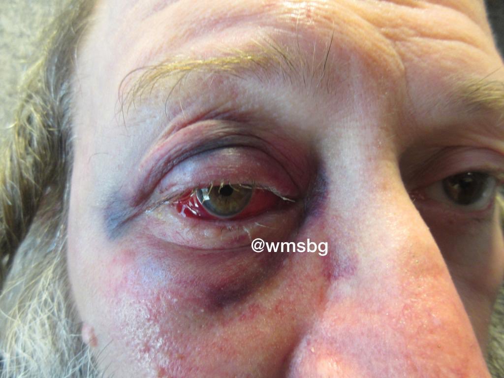 WMSBG's tweet image. Pictures of elderly jew who was viciously attacked on Monday morning by 4 thugs on Wythe pl, and broke his eye socket, @NYPD90Pct @NYPDDetectives is still looking for the suspects, contact @NYPDTips 800577TIPS or @WspuShomrim 7182370202 with any info.