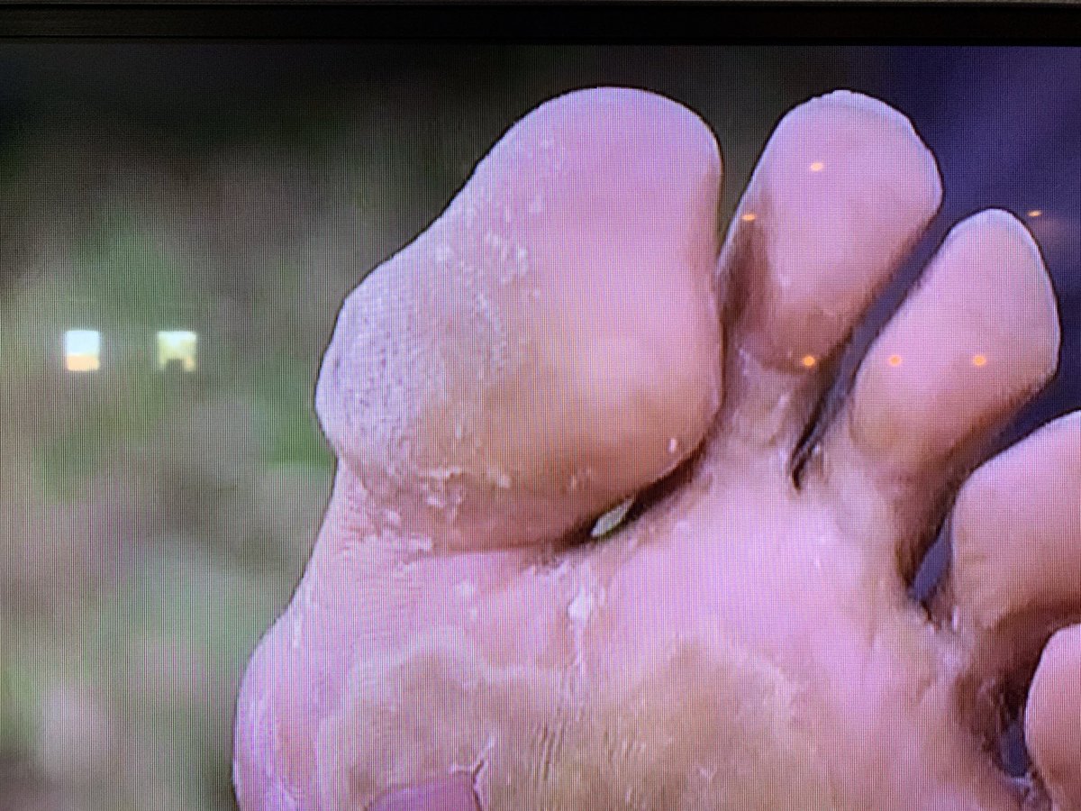 ryanblarson's tweet image. Antonio Brown’s big toe or Mario Bros. Goomba? @SportsSturm @NotJackKemp
