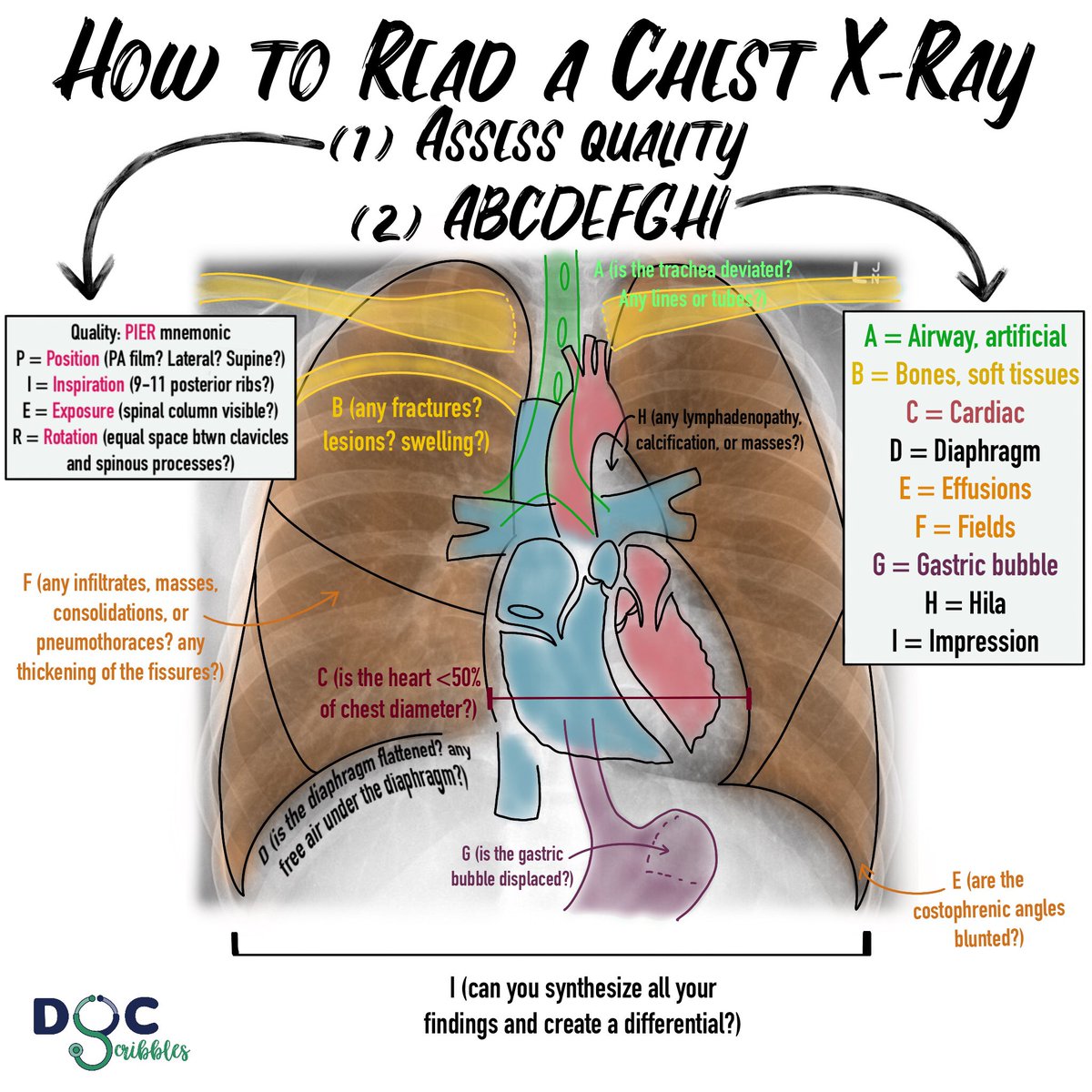 The ABCs of CXRs 
—————————
#MedEd #medicaleducation #FOAMed #FOAMrad #chestxray #CXR #Radiology #medtwitter 
Credit to @Radiopaedia for the original chest x-ray!