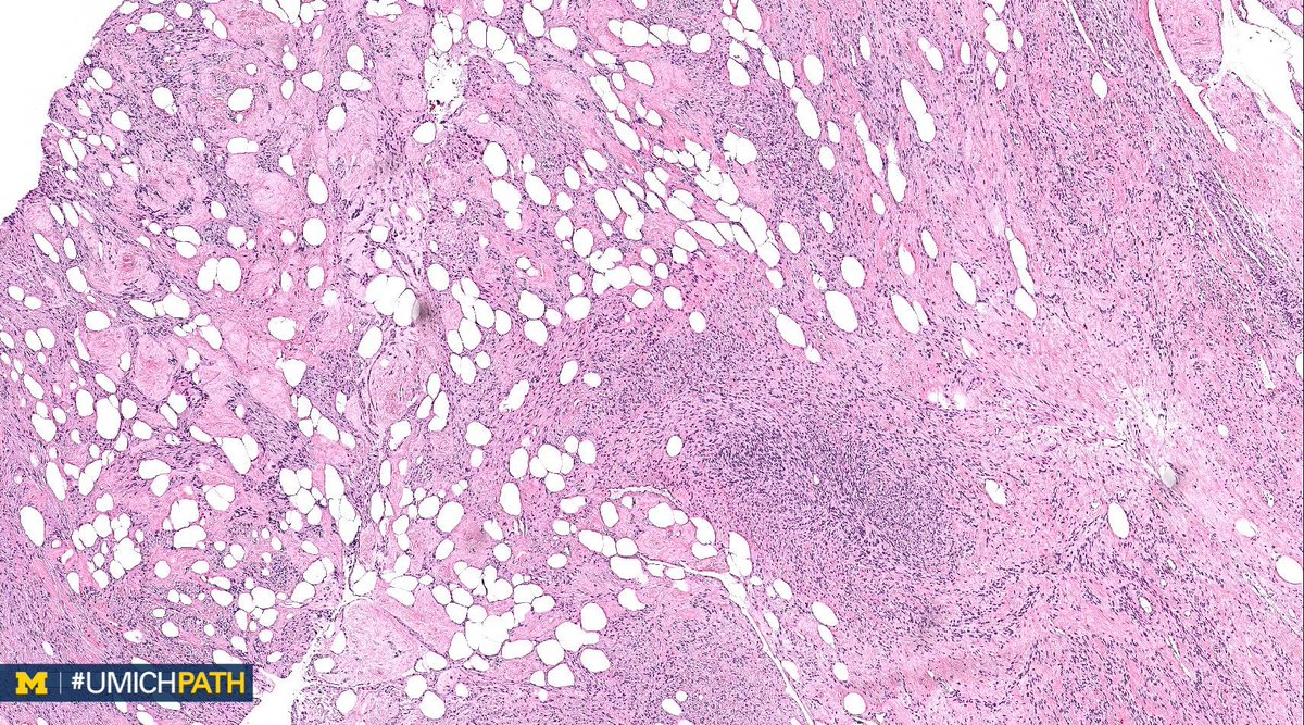 UMichPath's tweet image. A: Lipoleiomyoma. A variant of uterine leiomyomata.  Gross: Well circumscribed mass with alternating yellow and white areas. Histo: Variable admixture of bland smooth muscle cells and adipocytes. Very rarely can have glandular elements (adenolipoleiomyoma). #GYNPath #DailyDx