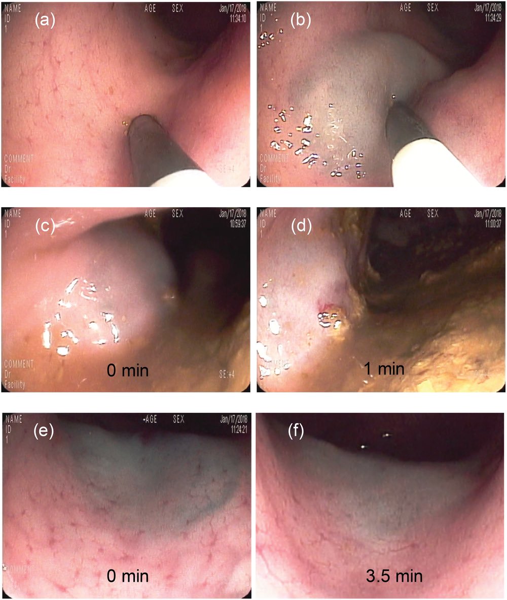 BrighamGI's tweet image. A novel, endoscopically injected shear-thinning gel developed in the lab of @cgtraverso, Brigham GI faculty and Assistant Professor at @MIT, may provide more durable cushioning for lift #polypectomy during #colonoscopy

onlinelibrary.wiley.com/doi/10.1002/ad…

news.mit.edu/2019/easier-re…